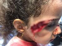حمله سگ‌های ولگرد به دختربچه ۵ ساله تبریزی