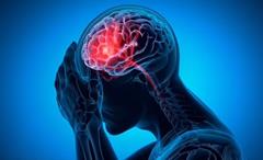 AI ژن‌های خطر سکته مغزی را کشف کرد